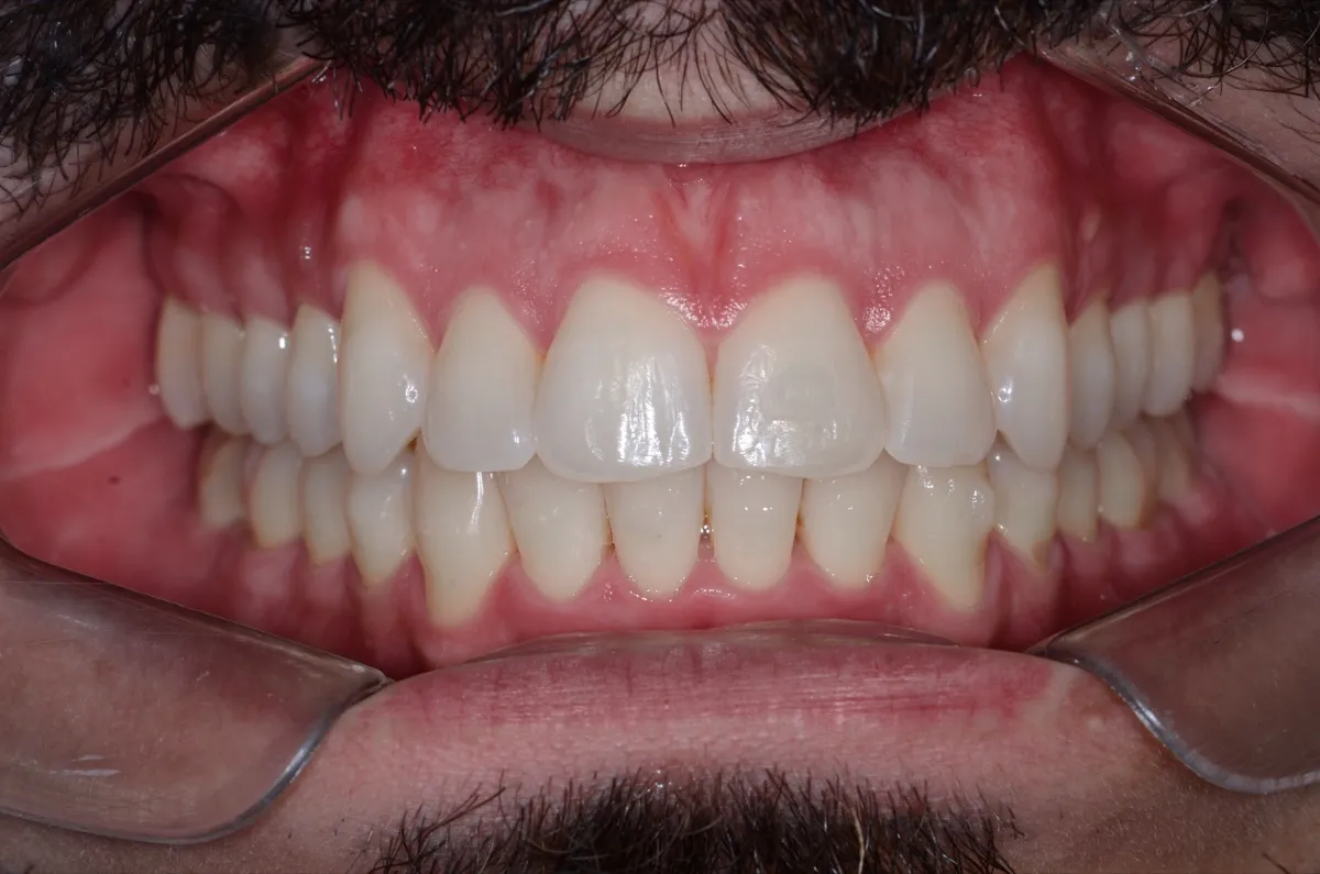Caso de alinhador invisível: dentes em vista frontal de paciente com barba