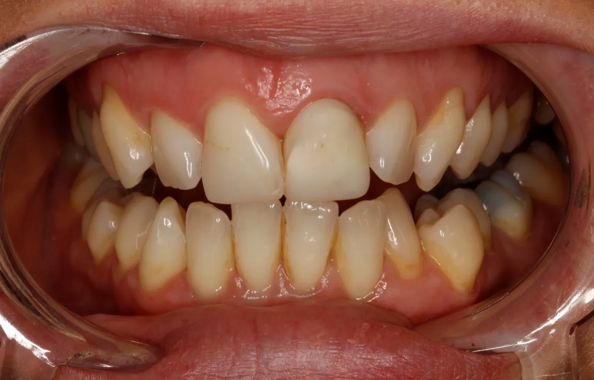 Caso de alinhador invisível: vista frontal dos dentes com afastador labial transparente