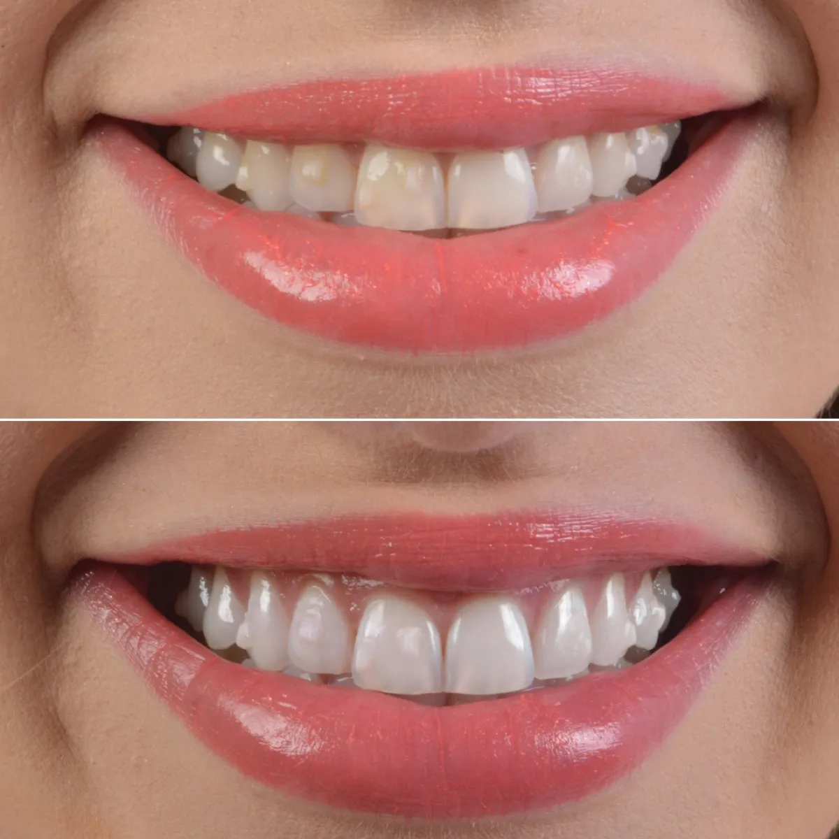 Antes e depois de um caso de clareamento dental, sorriso de paciente