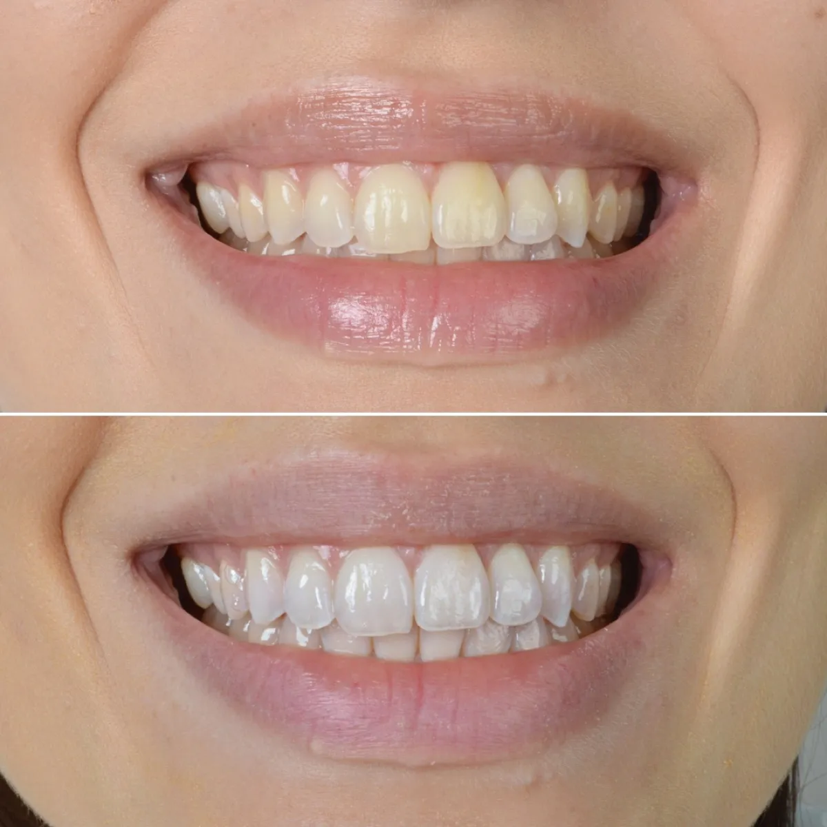 Antes e depois de outro caso de clareamento dental, sorriso de paciente