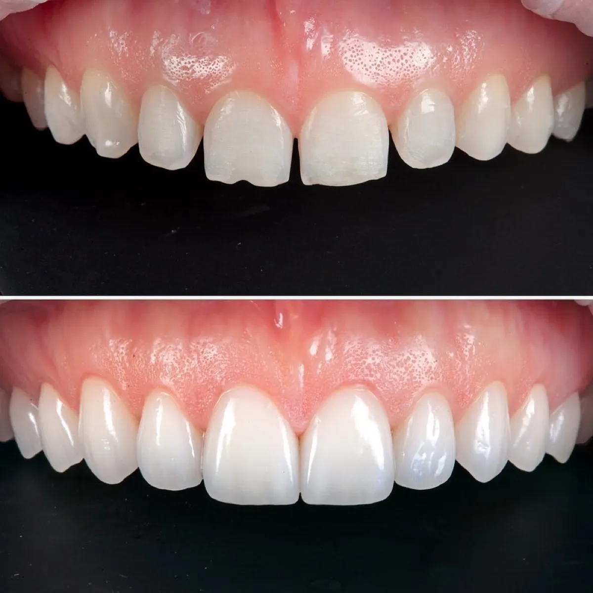 Antes e depois de um caso de facetas dentárias, dentes anteriores superiores em vista frontal