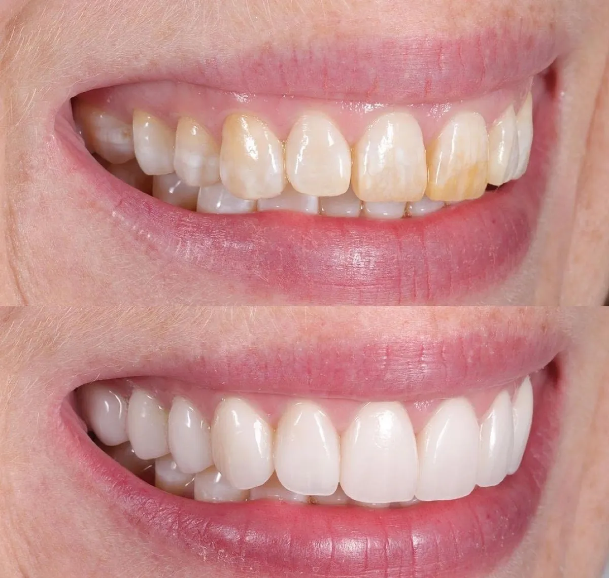 Antes e depois de um caso de facetas dentárias, sorriso de paciente