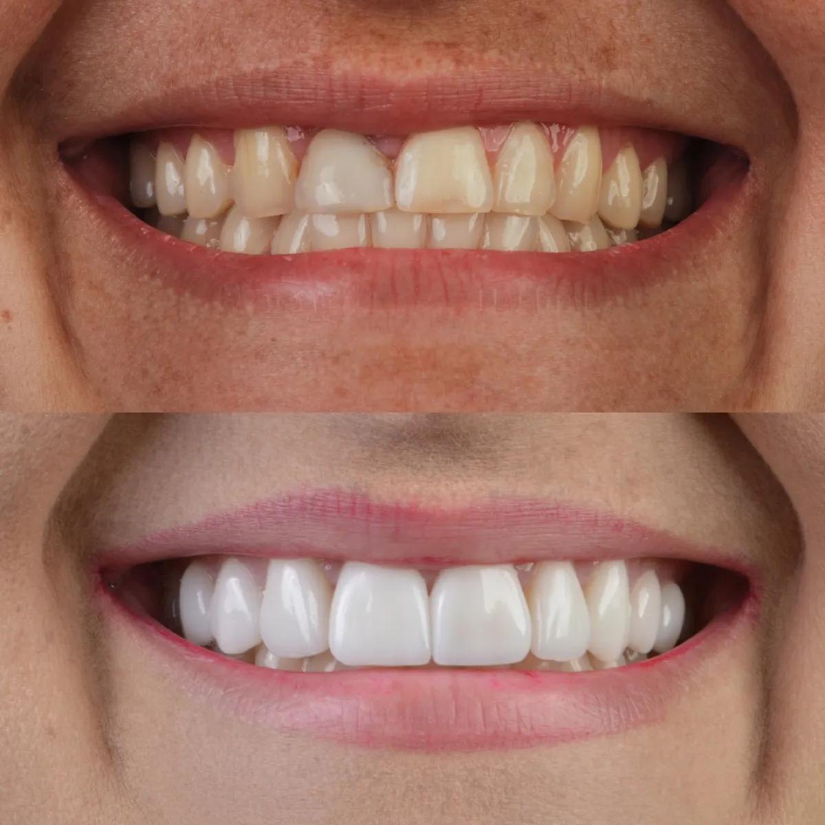Antes e depois de outro caso de facetas dentárias, sorriso de paciente