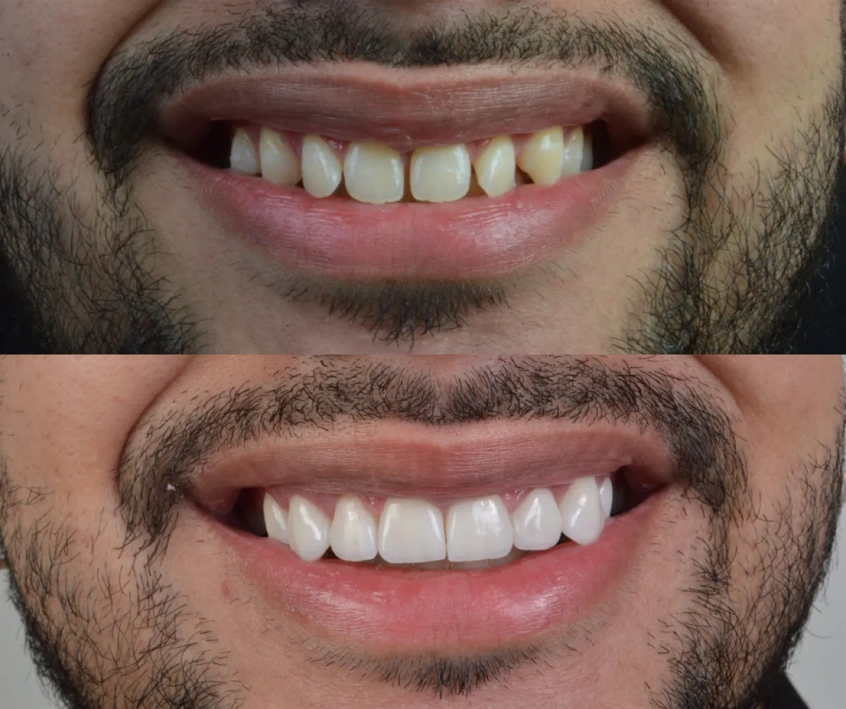 Antes e depois de um caso de facetas dentárias, sorriso de paciente com barba