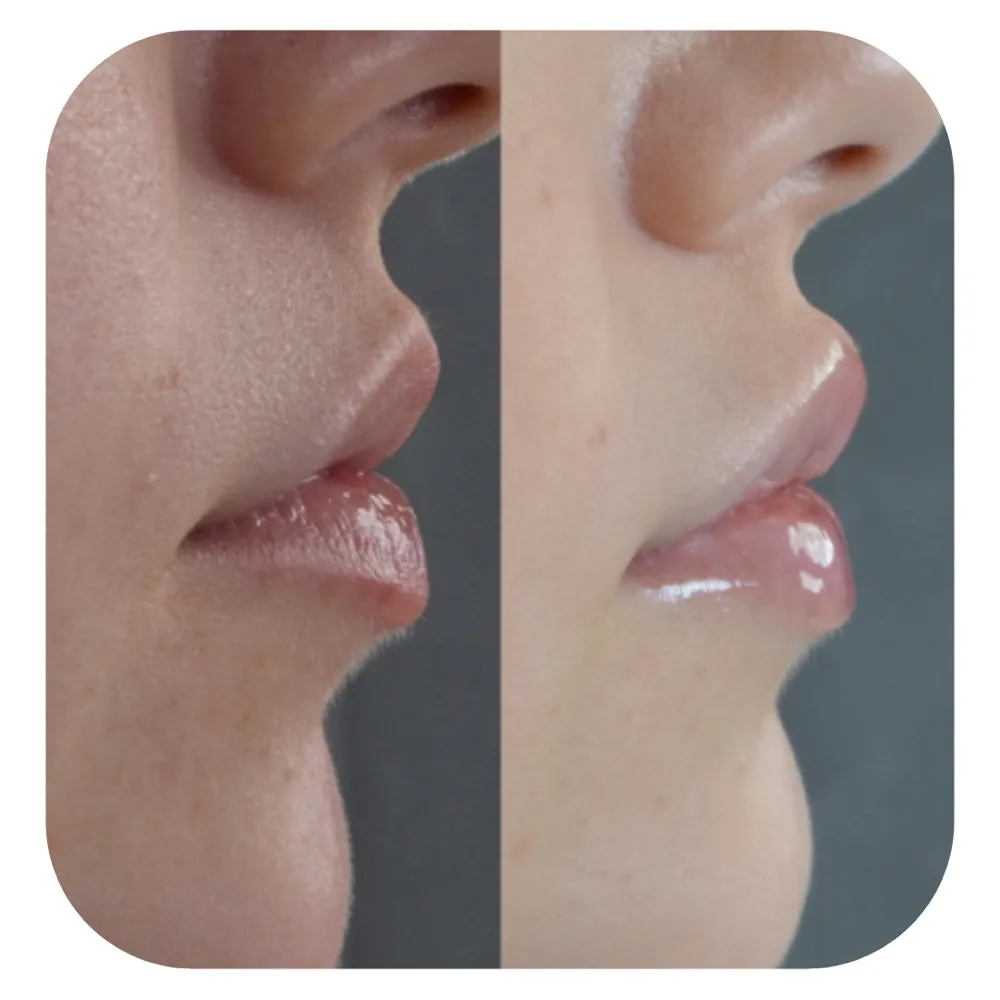 Antes e depois de preenchimento labial, em perfil