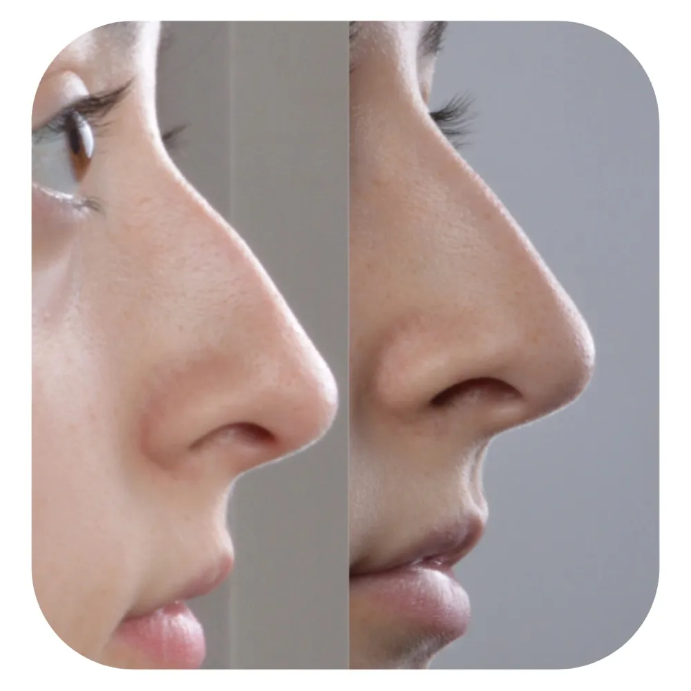 Antes e depois de rinomodelação, em perfil