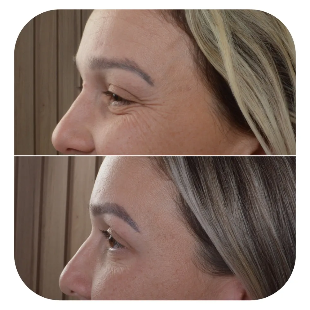 Antes e depois da lateral dos olhos