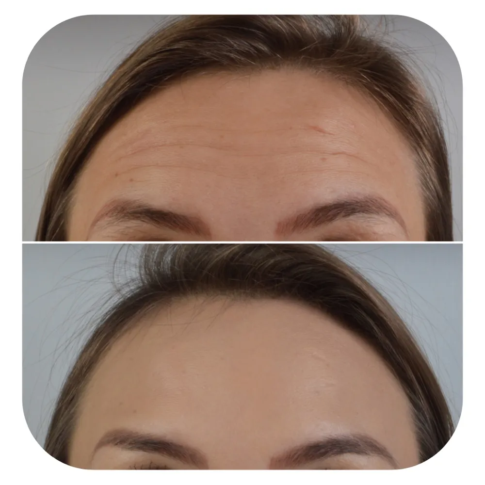 Antes e depois da região da testa
