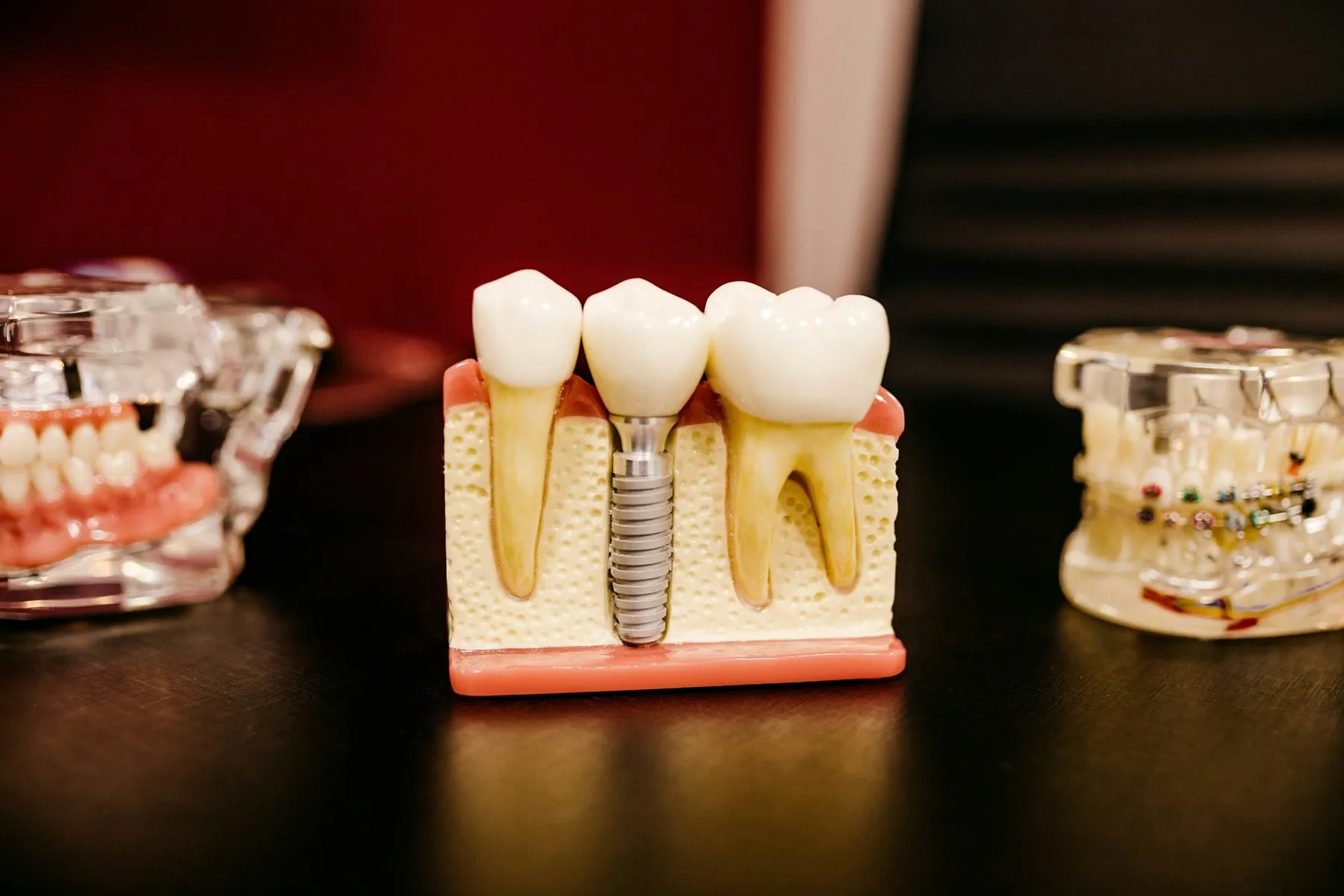 Modelo de implante entre dentes naturais