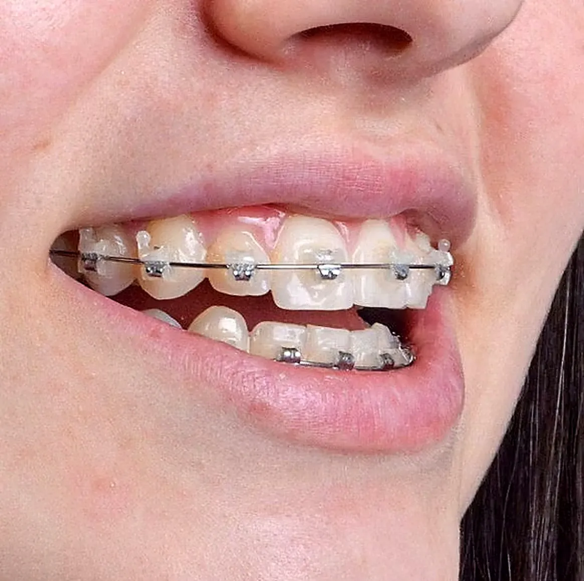 Sorriso com aparelho ortodôntico estético