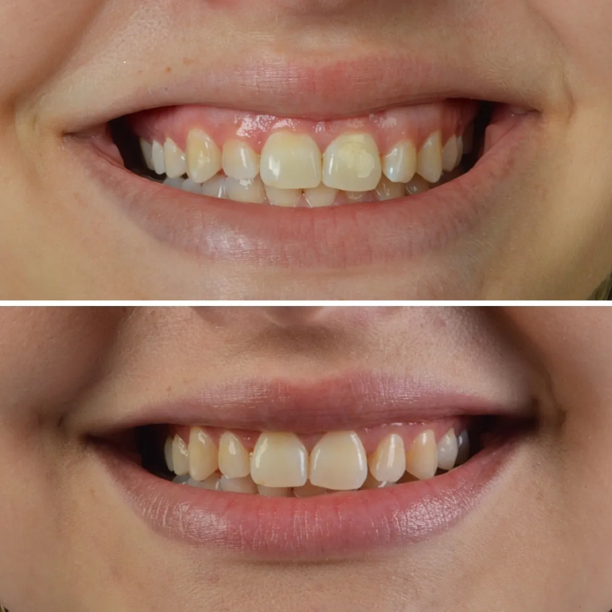 Antes e depois de um caso de gengivoplastia, sorriso de paciente