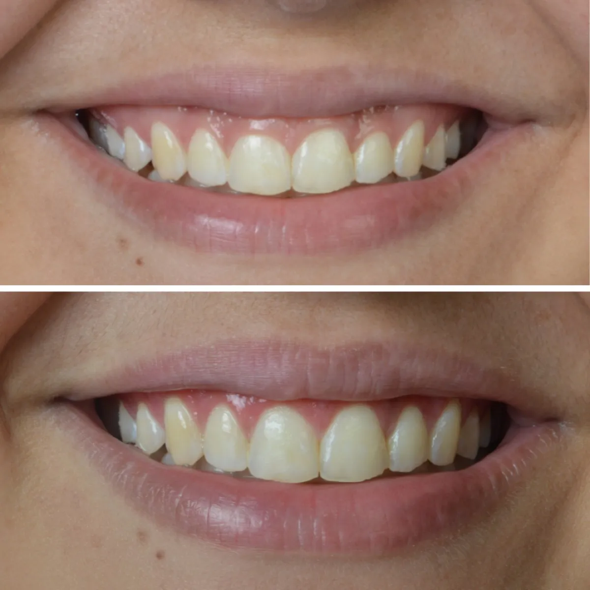 Antes e depois de outro caso de gengivoplastia, sorriso de paciente