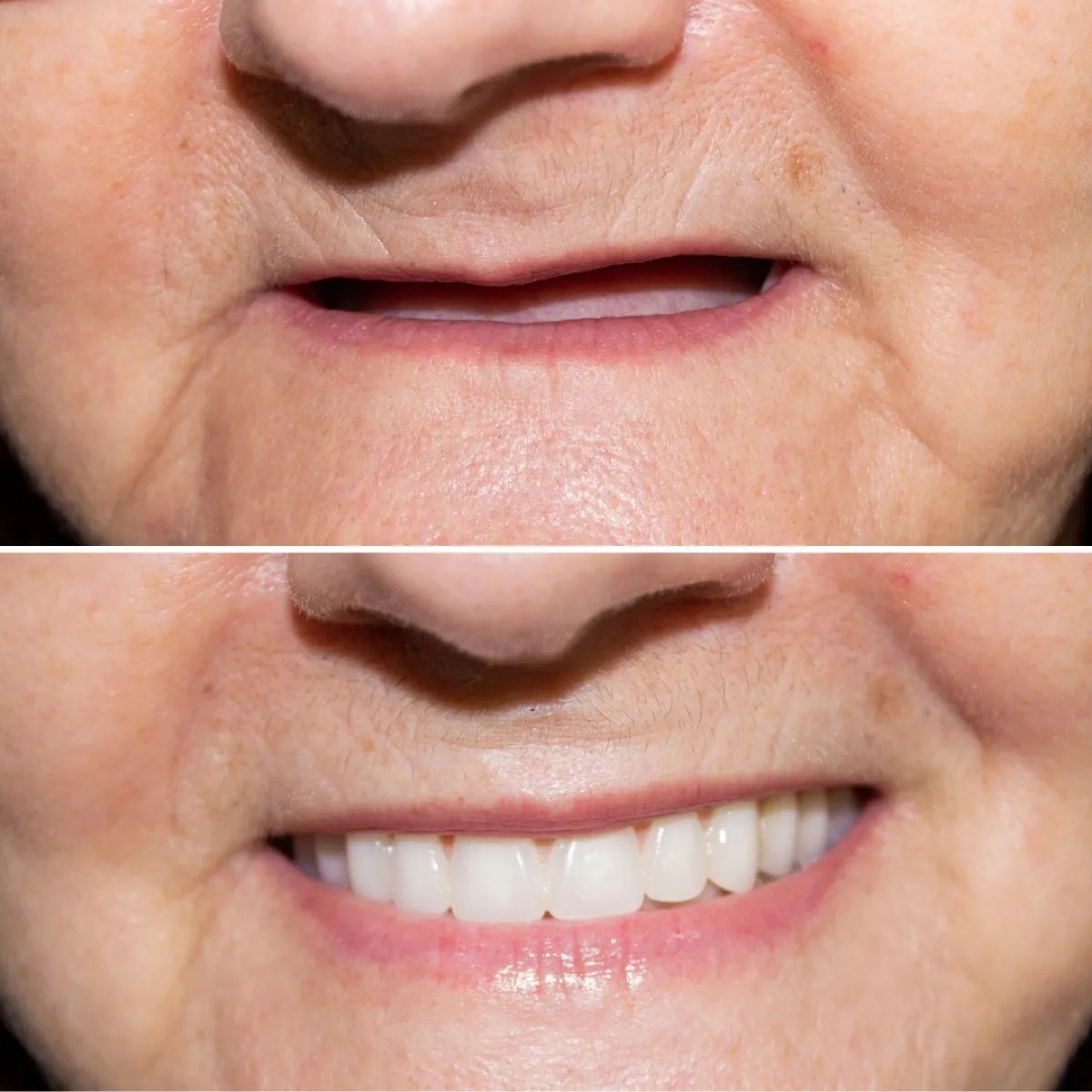 Antes e depois de um caso de prótese dentária, sorriso de paciente