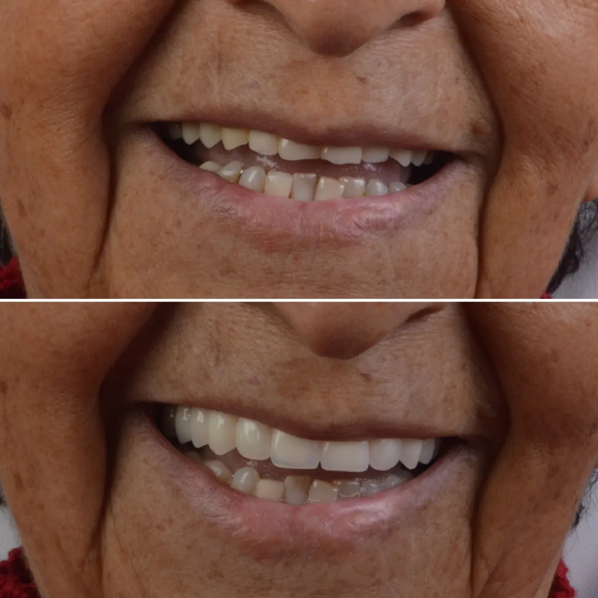 Antes e depois de outro caso de prótese dentária, sorriso de paciente