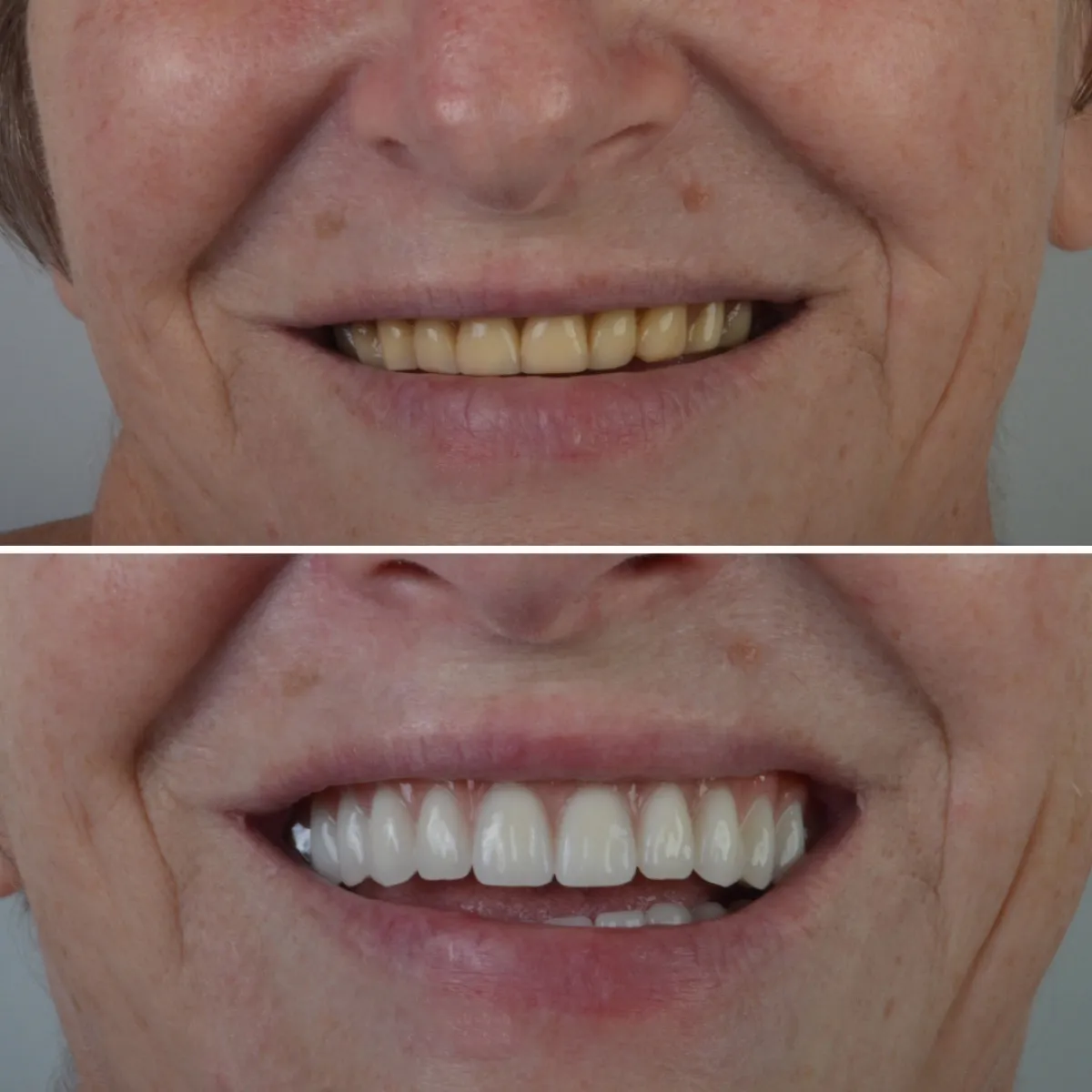 Antes e depois de um terceiro caso de prótese dentária, sorriso de paciente