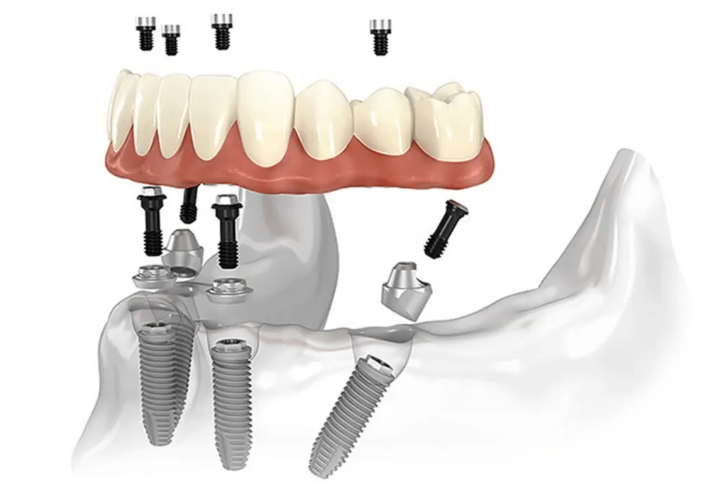 Esquema em 3D das peças do protocolo sobre quatro implantes, com dois implantes inclinados no fundo