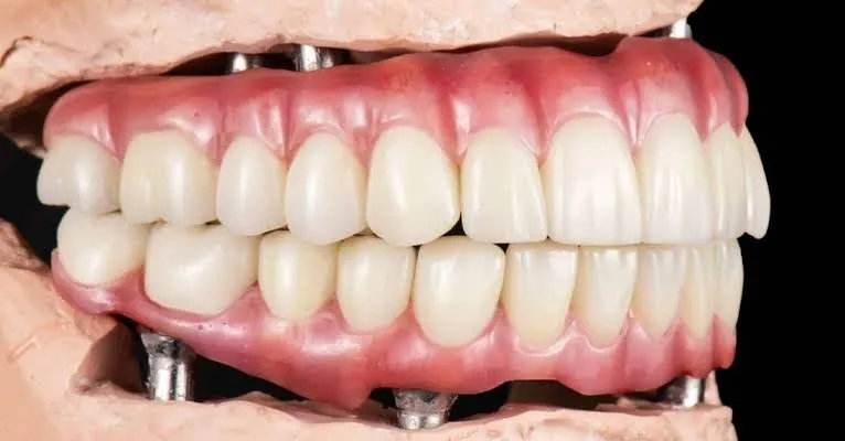 Prótese de arcada completa fixada sobre implantes, em modelo