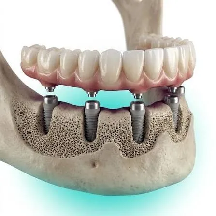 Ilustração 3D de uma mandíbula com quatro implantes sustentando uma prótese fixa